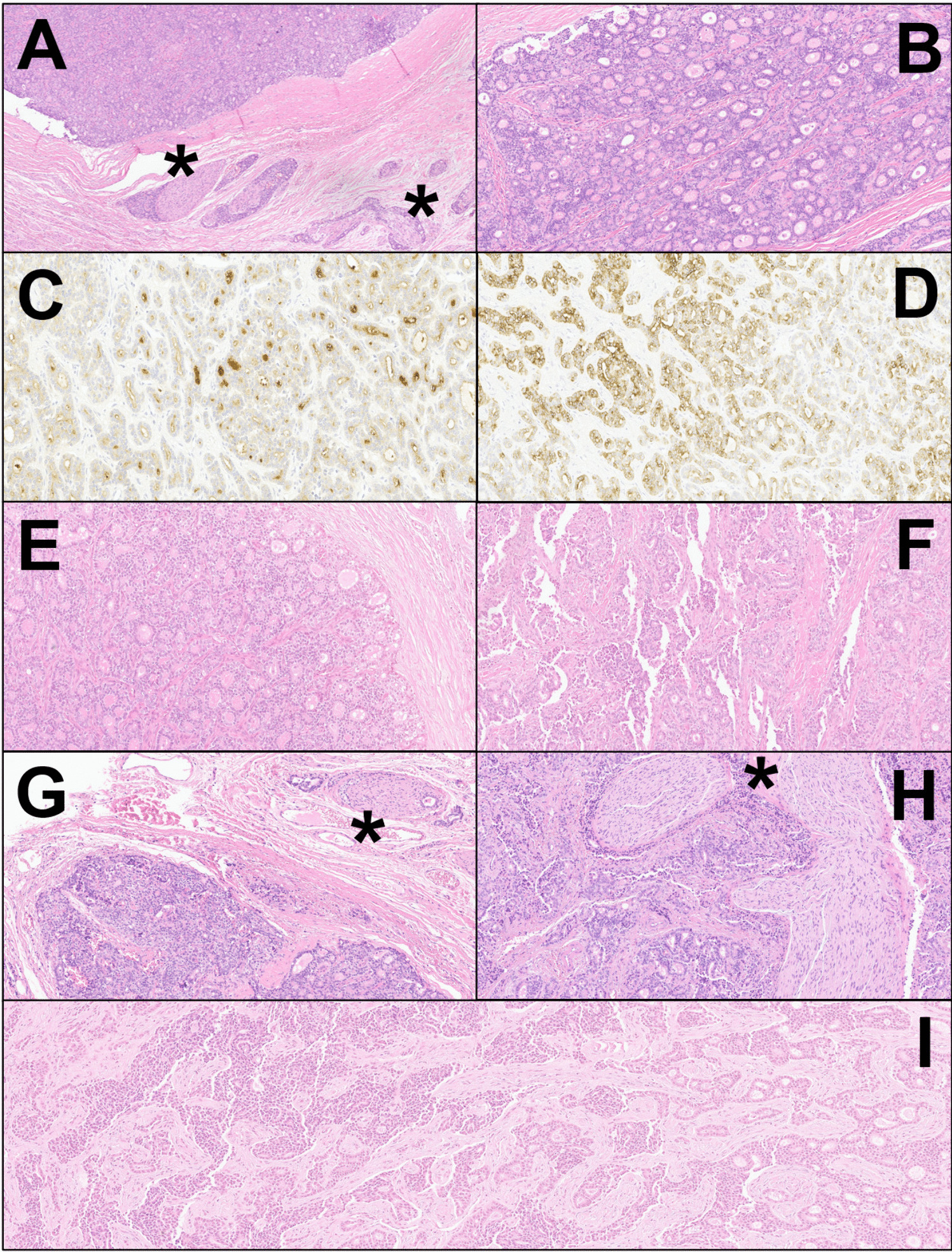 Long-Term Survivor of Intrahepatic Cholangiocarcinoma for over 18 Years: Case Study with Longitudinal Histo-molecular and Tumor Immune Microenvironment Characterization and Systematic Review of the Literature