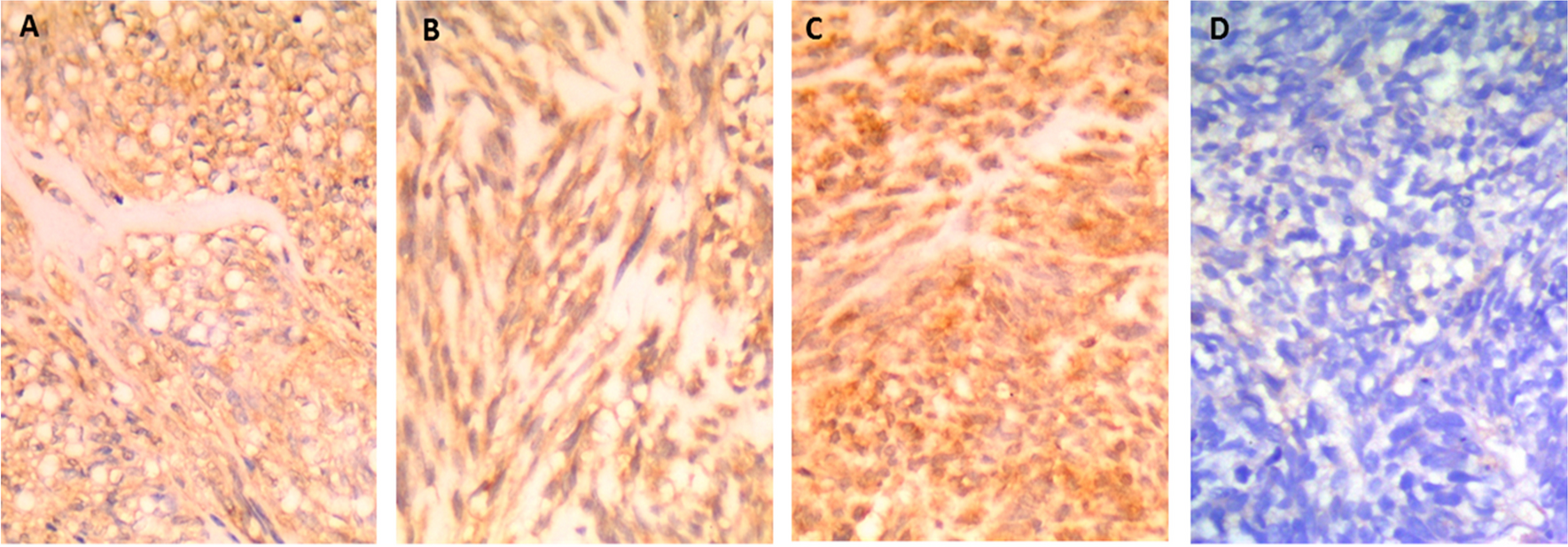 Immunohistochemical Expression of ROR2 in Gastrointestinal Stromal Tumor