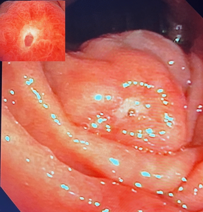 Endoscopic Ultrasound-Guided Coil and Glue Injection for Bleeding Duodenal Varix Using a Forward Viewing Echoendoscope