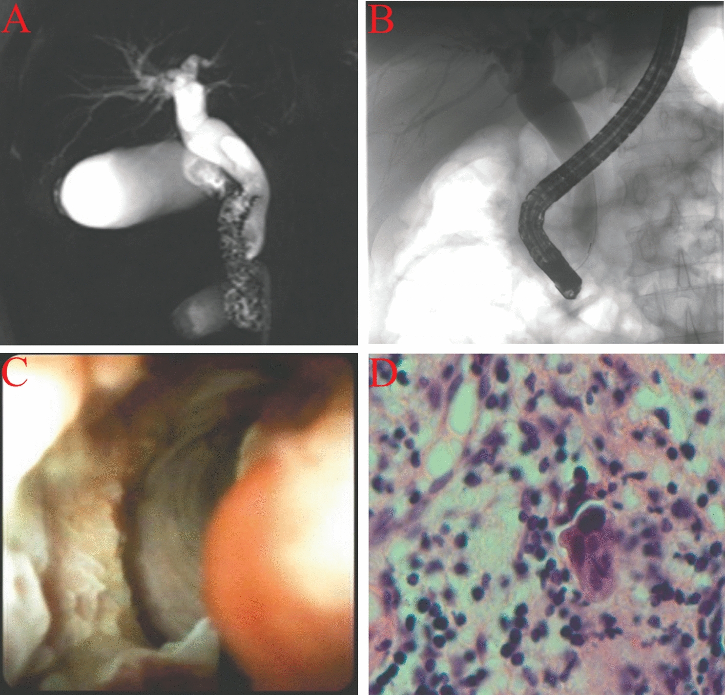 A Case of Imaging-Negative Distal Cholangiocarcinoma Diagnosed by Novel Spyglass Transoral Cholangioscope