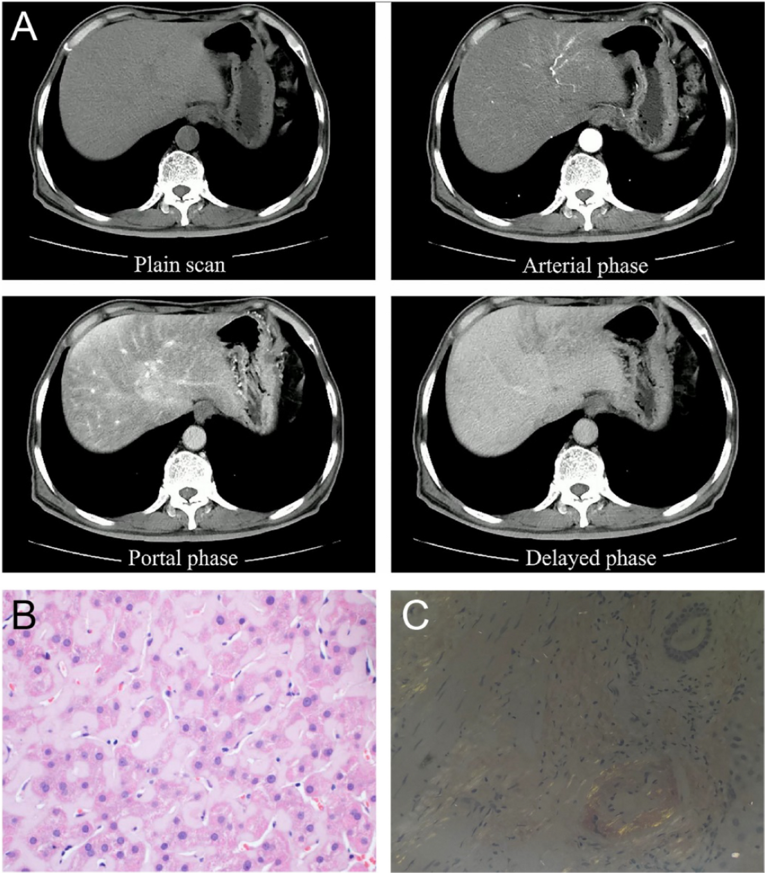 Hepatic Amyloidosis Without Hepatomegaly