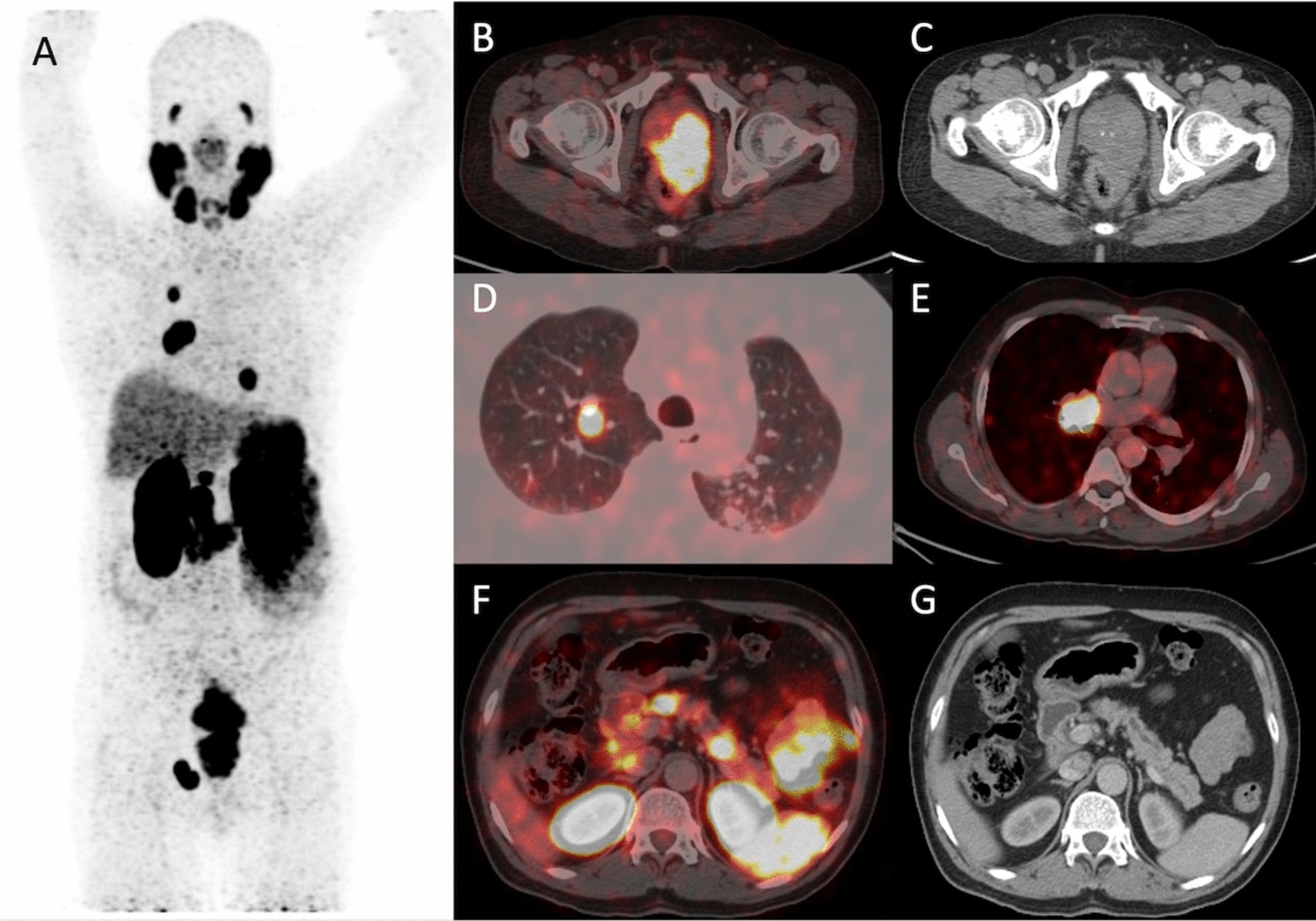 Prostatic Adenocarcinoma Taking an Unusual Route: Rare Case of Pancreatic Metastasis