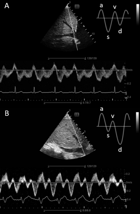 Hepatic vein Doppler ultrasound to estimate central venous pressure in mechanically ventilated children