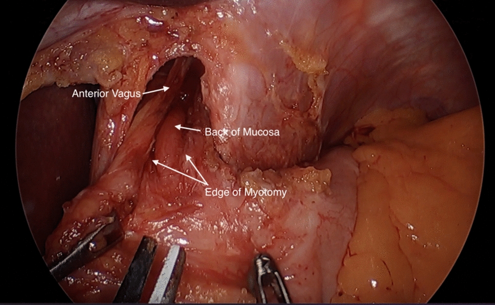 Surgical management of achalasia