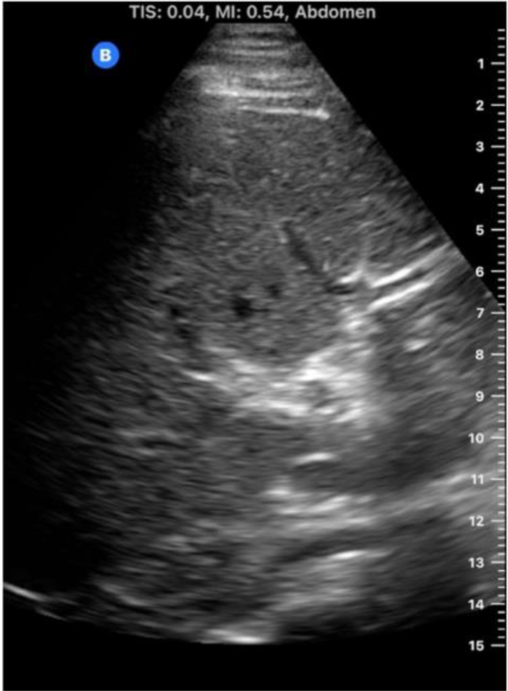 Classics in abdominal radiology: the jumping deer sign
