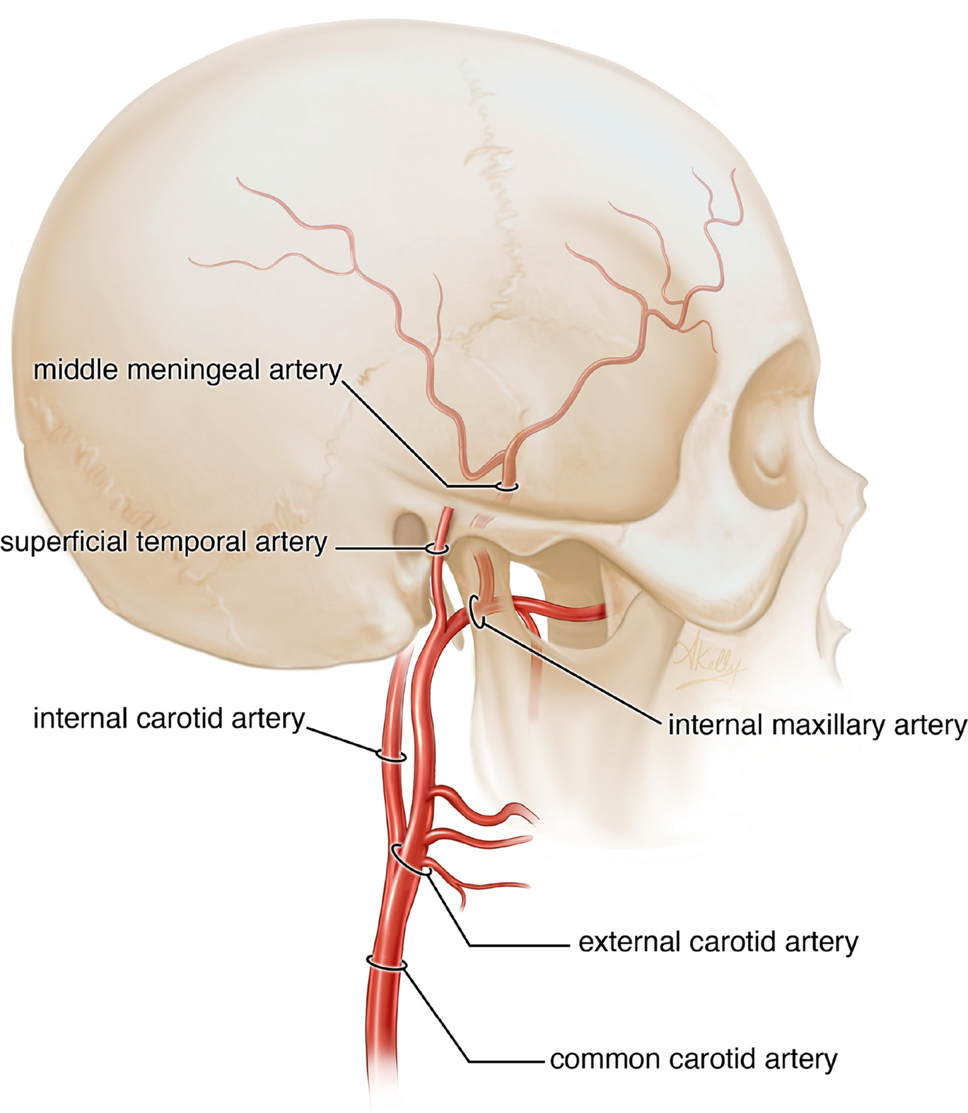 Newer treatment paradigm improves outcomes in the most common neurosurgical disease of the elderly: a literature review of middle meningeal artery embolization for chronic subdural hematoma