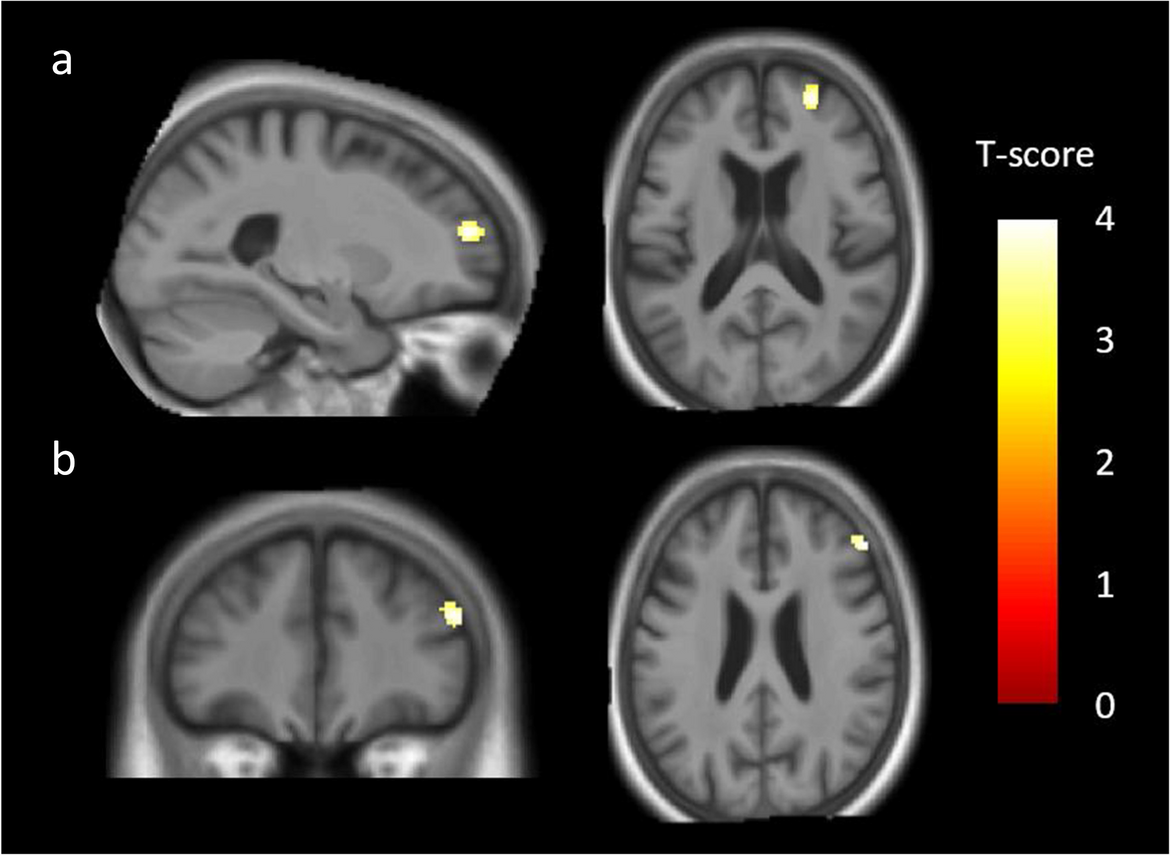 Neuroanatomical substrates of depression in dementia with Lewy bodies and Alzheimer’s disease