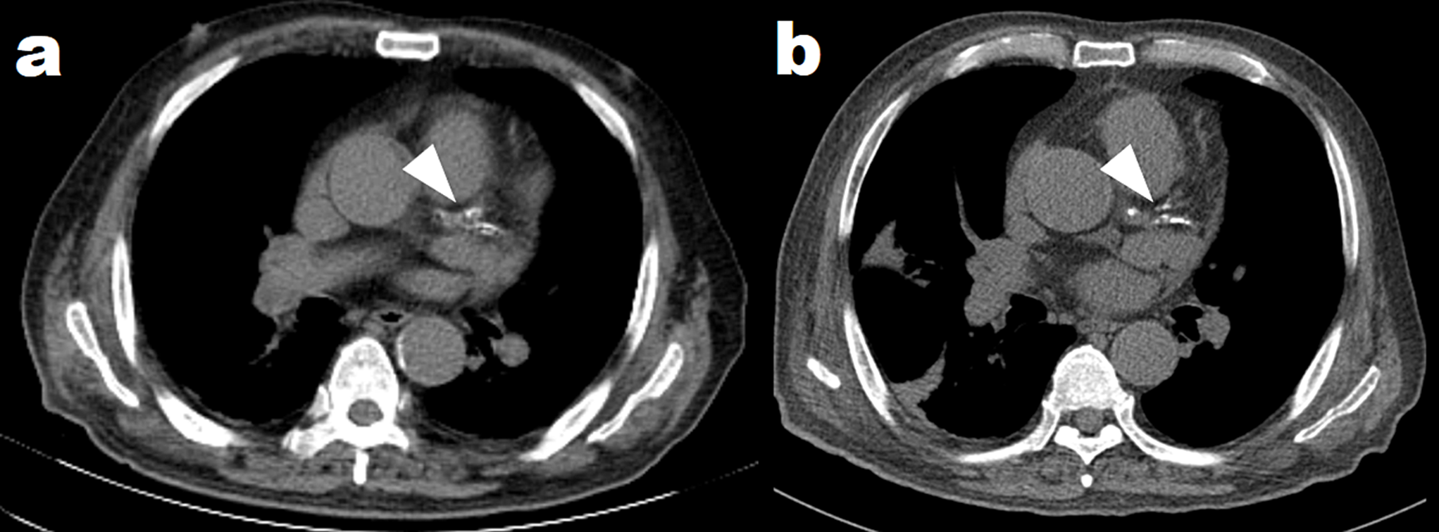 Incidental Coronary Artery Calcification Detected on Preoperative PET/CT: Implications for Postoperative Mortality