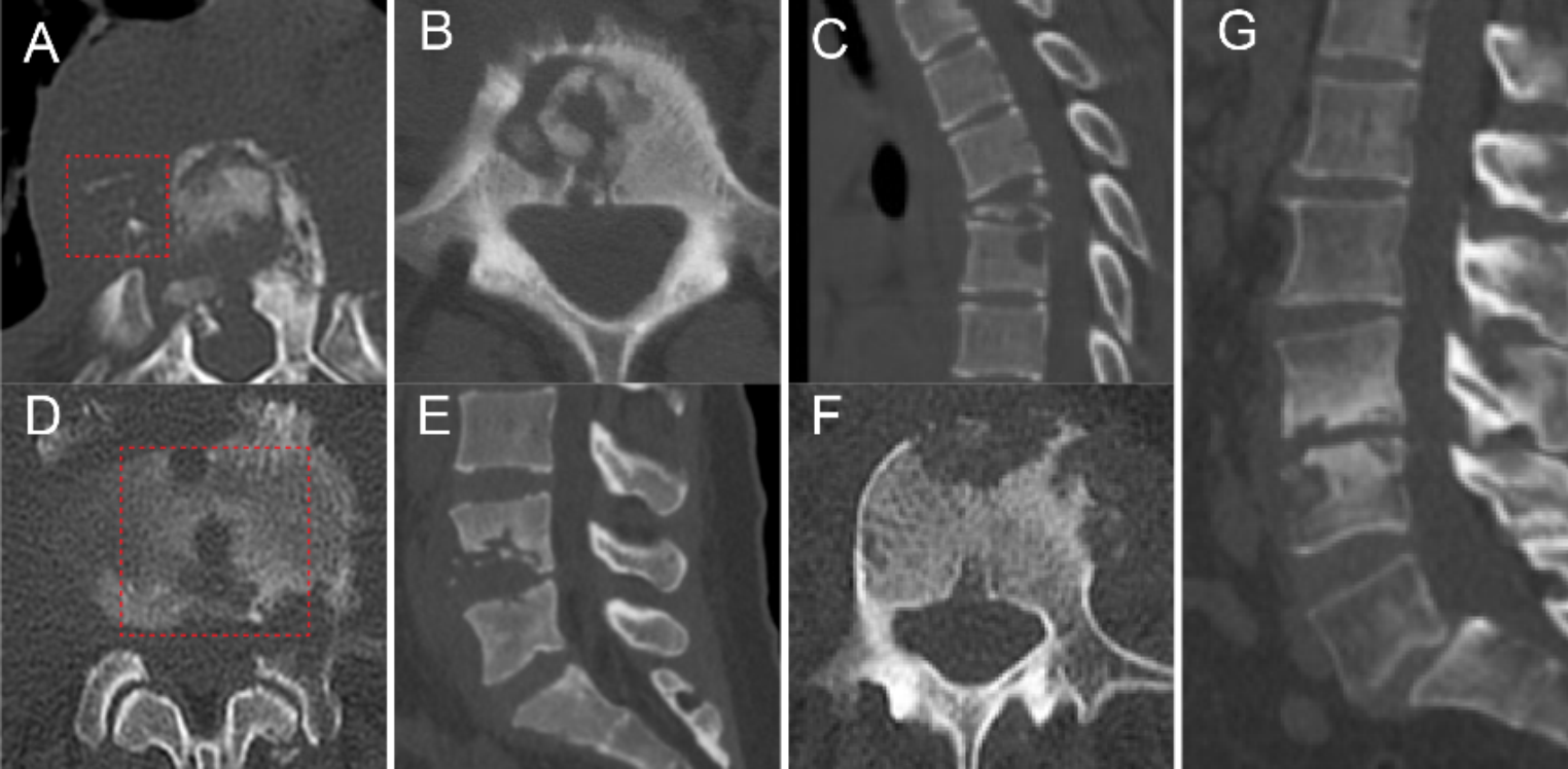 A diagnostic model for differentiating tuberculous spondylodiscitis from pyogenic spondylodiscitis based on pathogen-confirmed patients