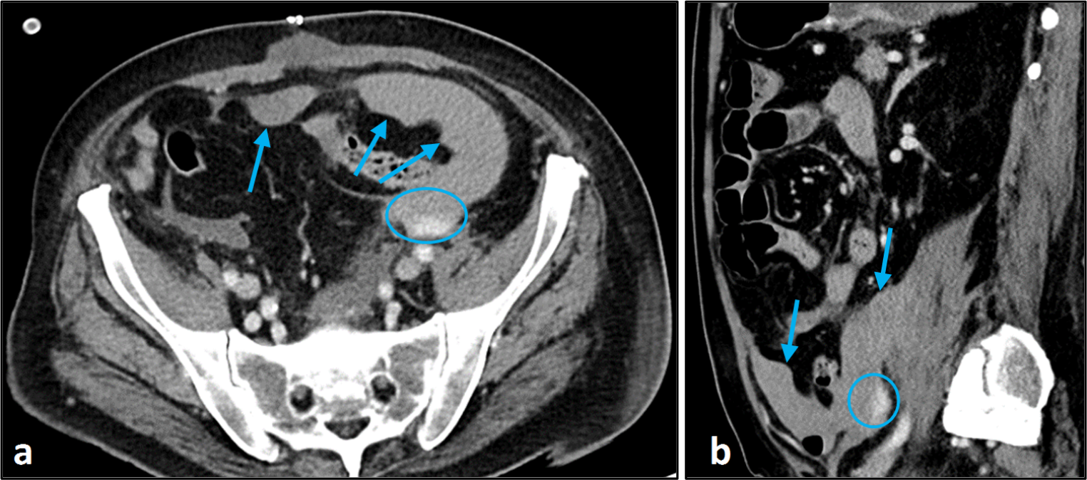 Isolated vertebral bone infarction following lumbar artery embolization- a case report