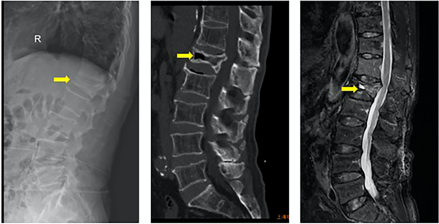 The surgical strategy selection and clinical efficacy analysis of Kummell’s disease