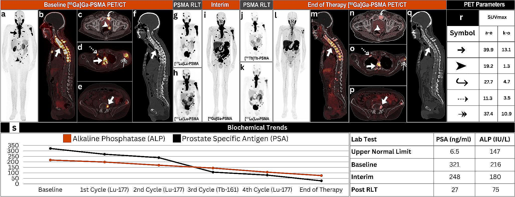 Dual Radionuclide Therapy: The Synergistic Effects of [161Tb]Tb-PSMA and [177Lu]Lu-PSMA in Advanced Prostate Cancer Post [177Lu]Lu-PSMA Failure