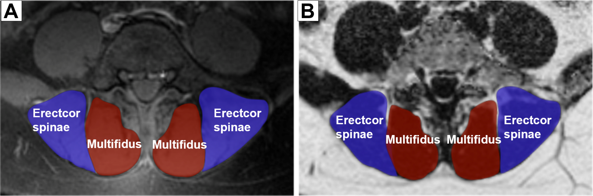 Quantitative magnetic resonance imaging of paraspinal muscles for assessing chronic non-specific low back pain in young adults: a prospective case-control study