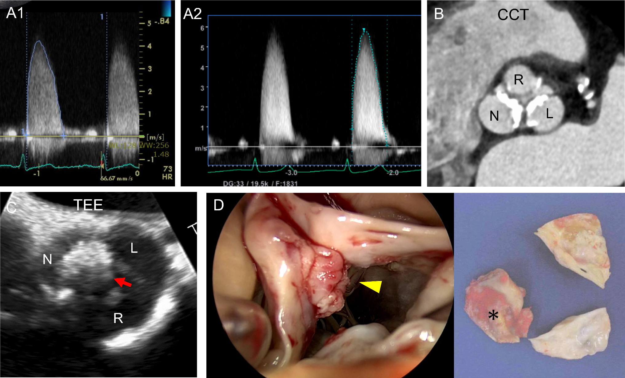 Rapid “progression” of aortic stenosis due to infective endocarditis on the noncoronary cusp