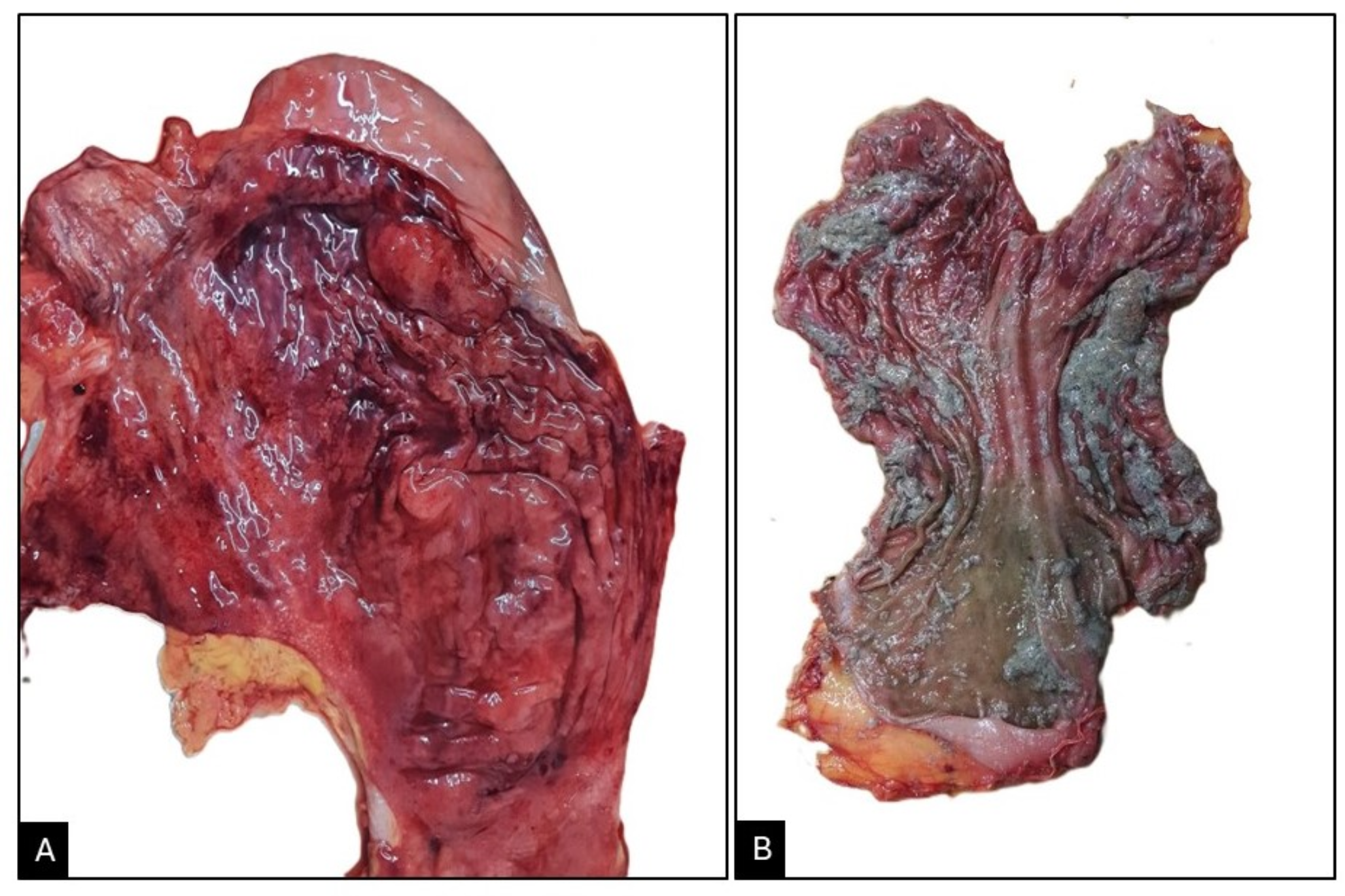 Incidental detection of aluminum phosphide in abdominal subcutaneous fat- a rare reporting of chemical analysis findings in poisoning cases
