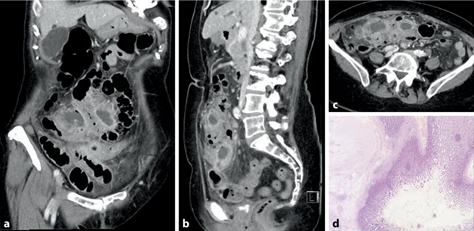 Perforated small bowel diverticular disease: a case report to raise awareness for surgical treatment in complicated jejunal diverticulitis