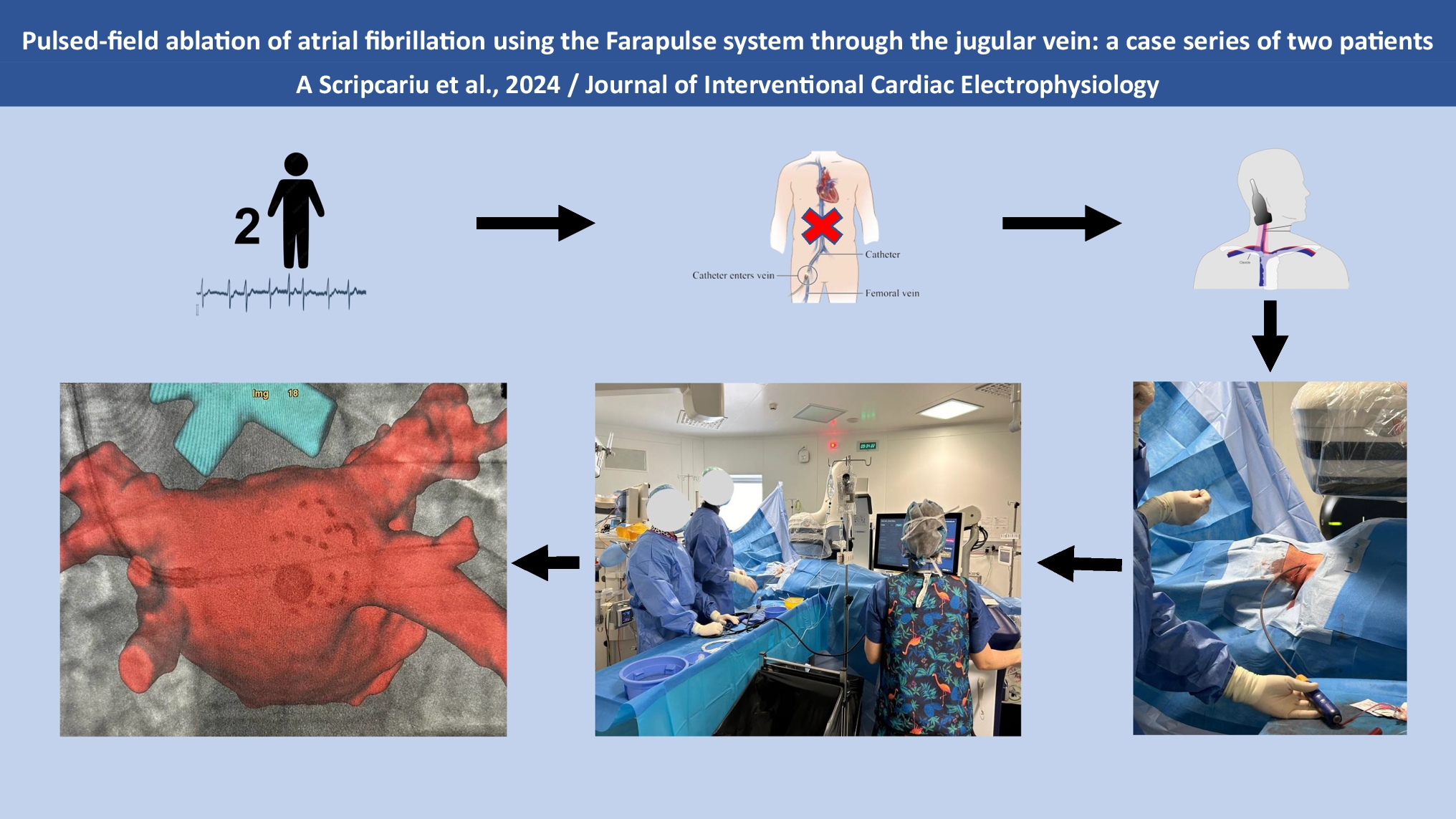 Pulsed-field ablation of atrial fibrillation using the Farapulse system through the jugular vein: a case series of two patients