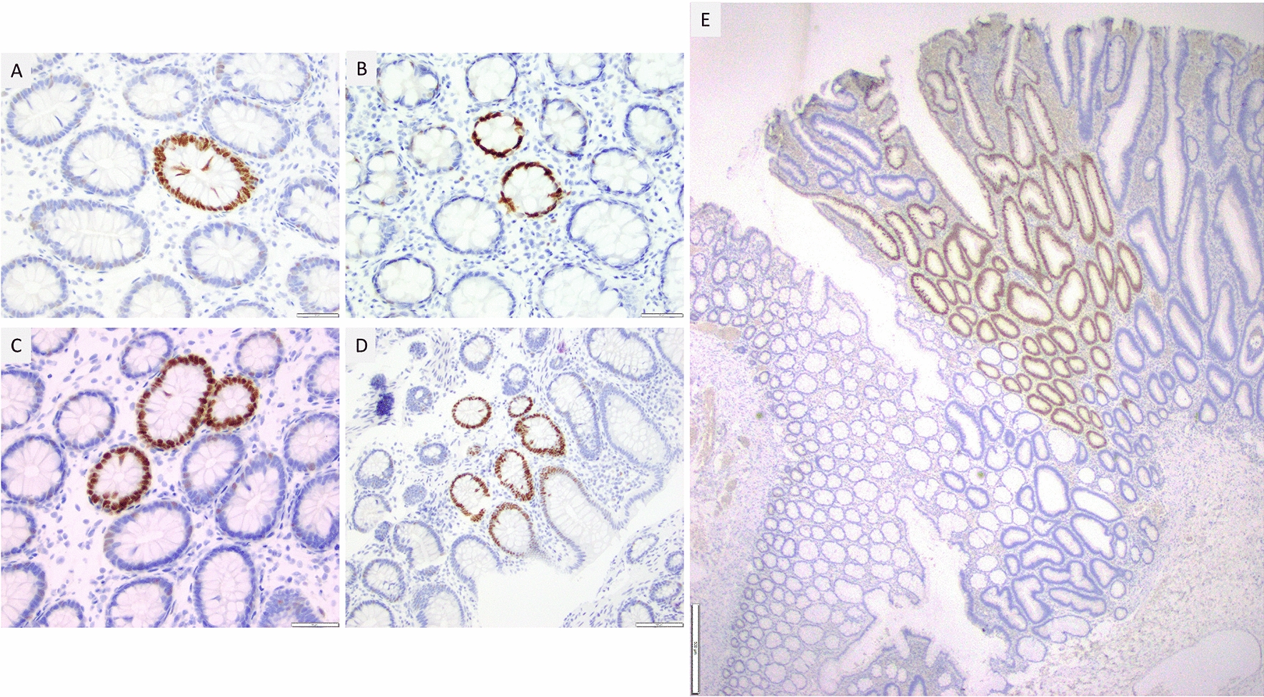 MSH6-proficient crypt foci in MSH6 constitutional mismatch repair deficiency: reversion of a frameshifted coding microsatellite to its wild-type sequence