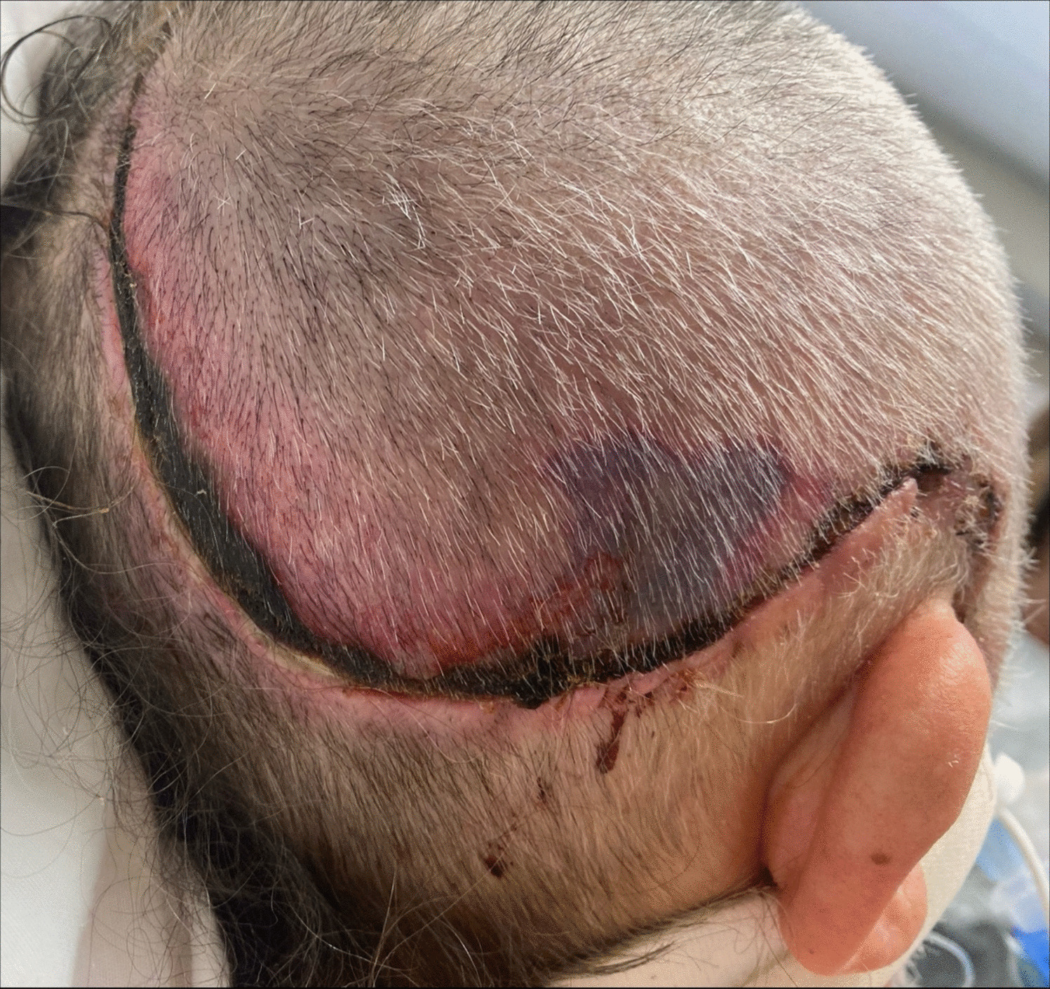 Postoperative Neurosurgical Complications in Neurocritical Care