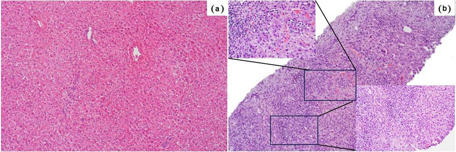Investigation of the relationship of tissue-resident γδ T cells and IL-17 gene expression with the pathogenesis of autoimmune hepatitis