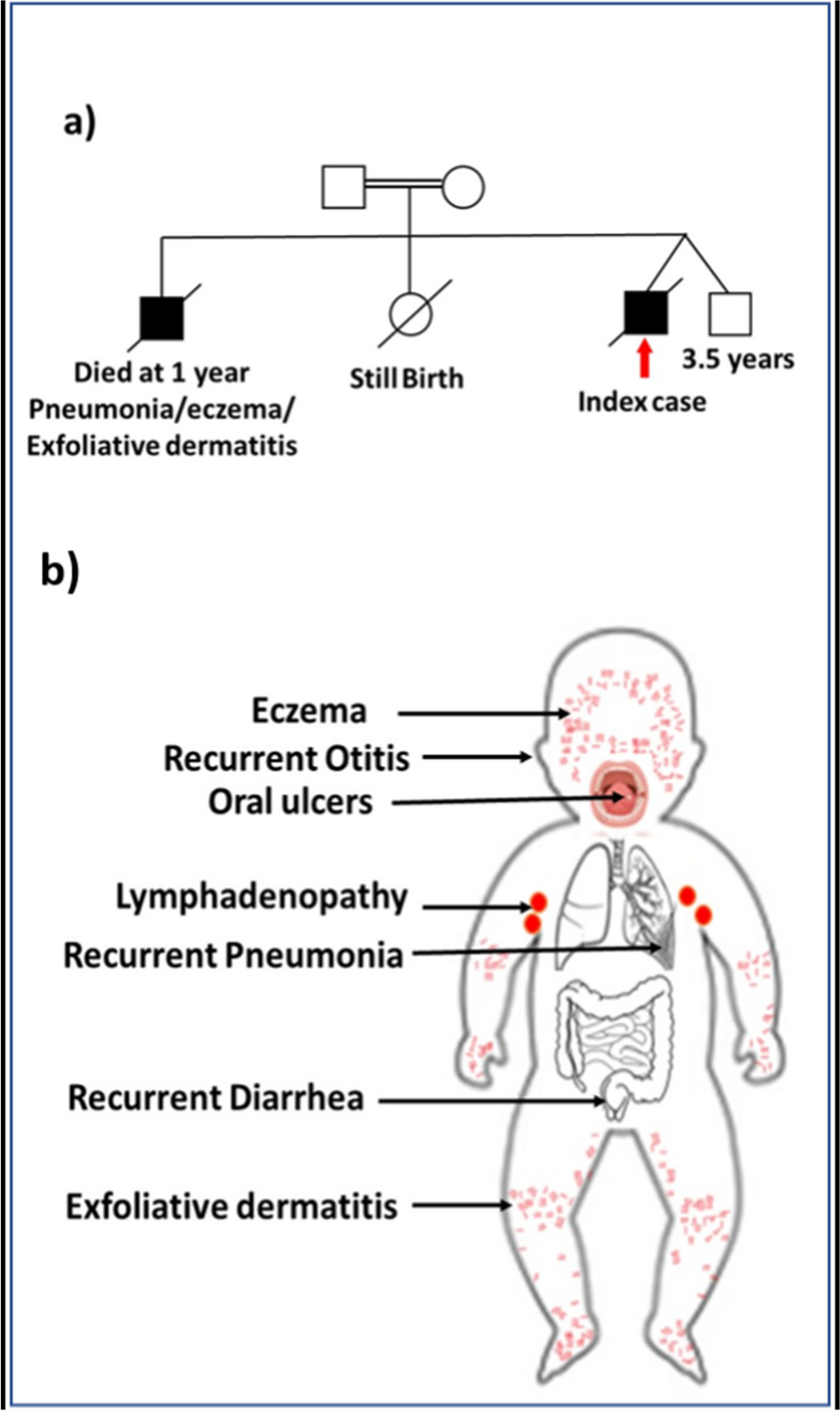 A novel MALT1 variant in an Egyptian patient presenting with exfoliative dermatitis: a case-based review