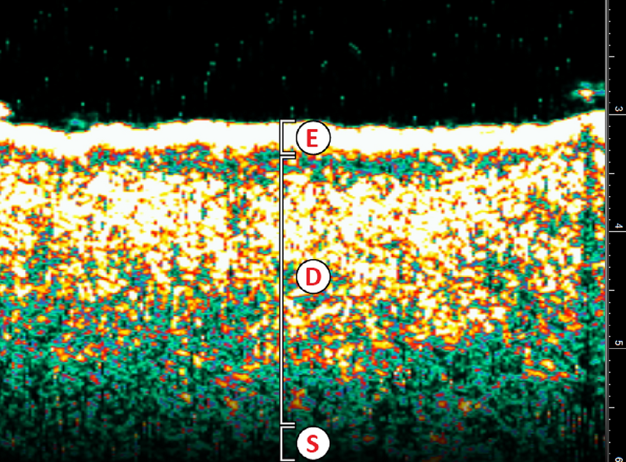 The State of the Art of Image Guided Superficial Radiation Therapy Treatment of Non-melanoma Skin Cancer in Outpatient Dermatology Clinics in the United States and Review of the Literature