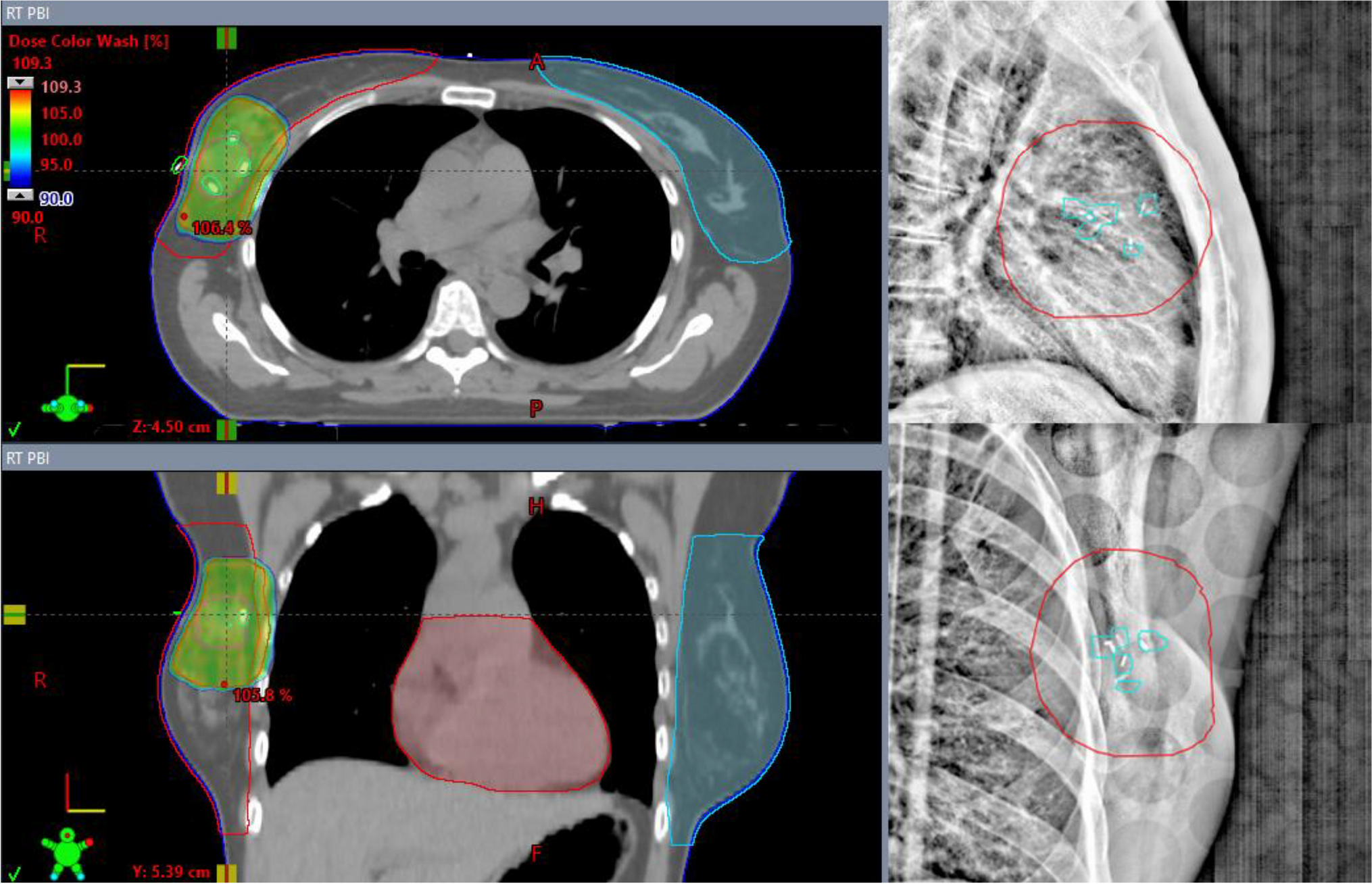 “When Less is More”: Paradigm Shifts in Radiation Treatment for Early-Stage Breast Cancer
