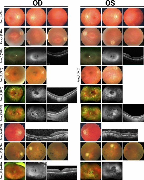 Coding and non-coding variants in the ciliopathy gene CFAP410 cause early-onset non-syndromic retinal degeneration
