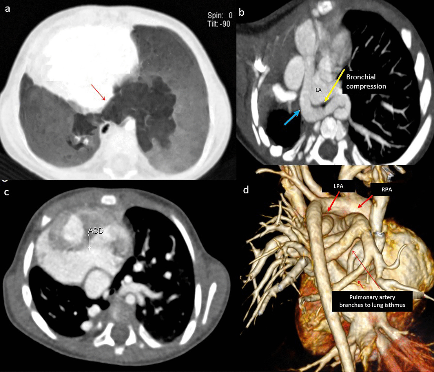 Vascular Arcade Causing Bronchial Compression in a Case of Horseshoe Lung