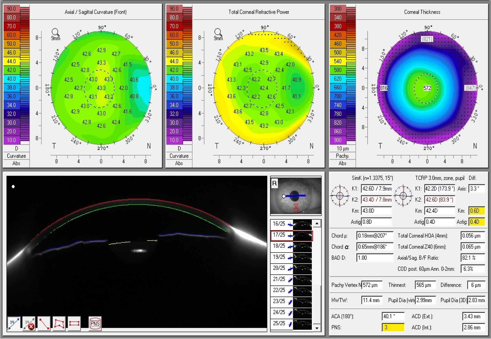 Corneal and lens densitometry evaluation with Pentacam HR in children and adolescents with beta thalassemia major: a case–control study