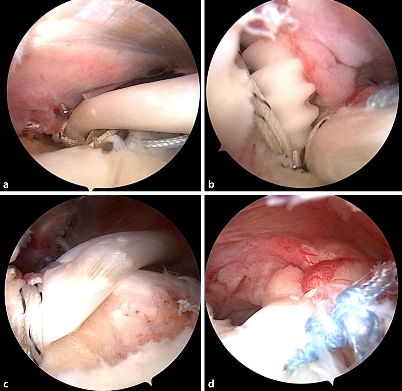 Clinical outcomes of superior capsular reconstruction using the long head of the biceps tendon for irreparable rotator cuff tears: a 1-year follow-up study