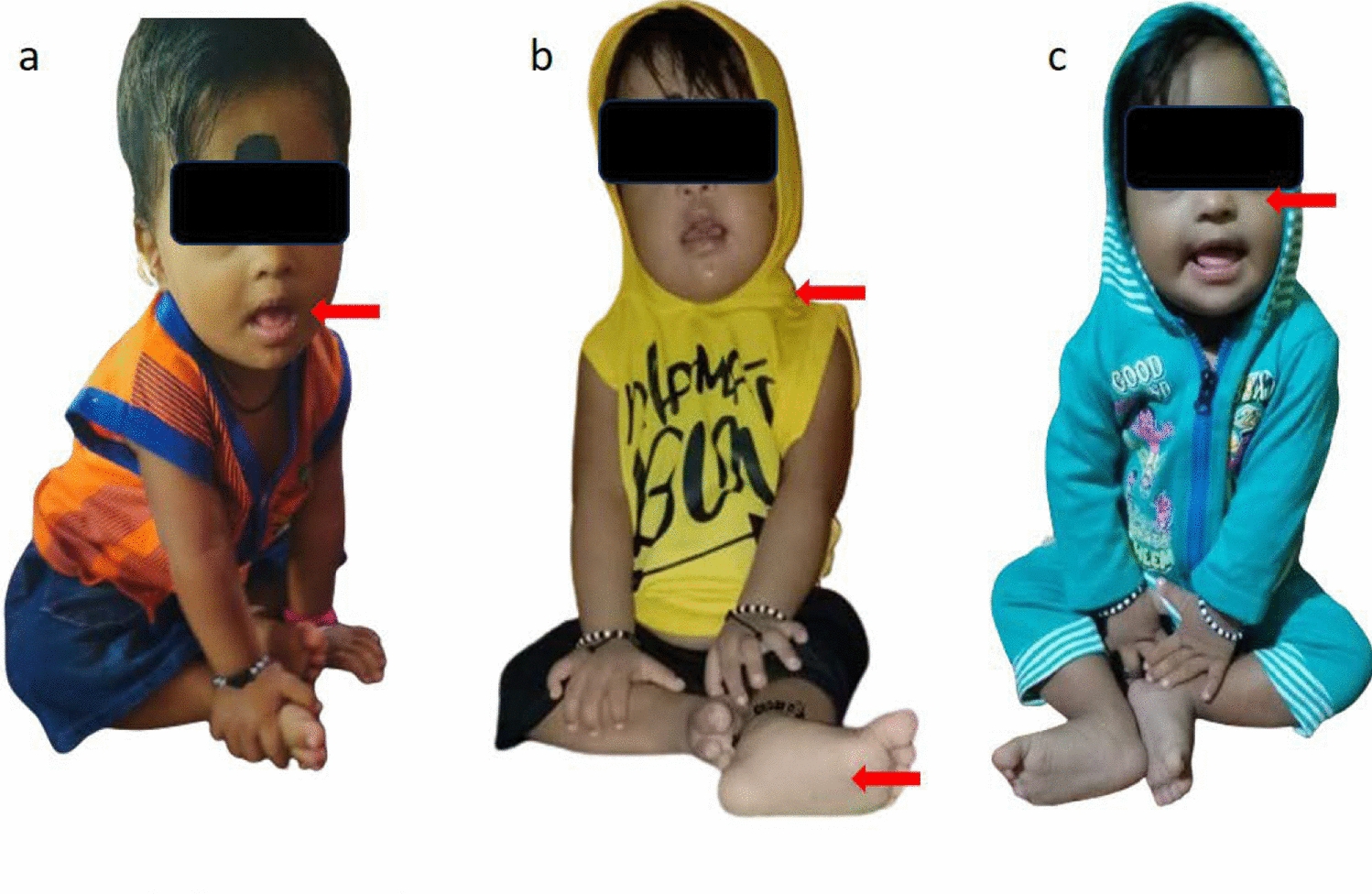 A case of double aneuploidy of Down and Klinefelter syndrome in an Indian infant: a detailed case report