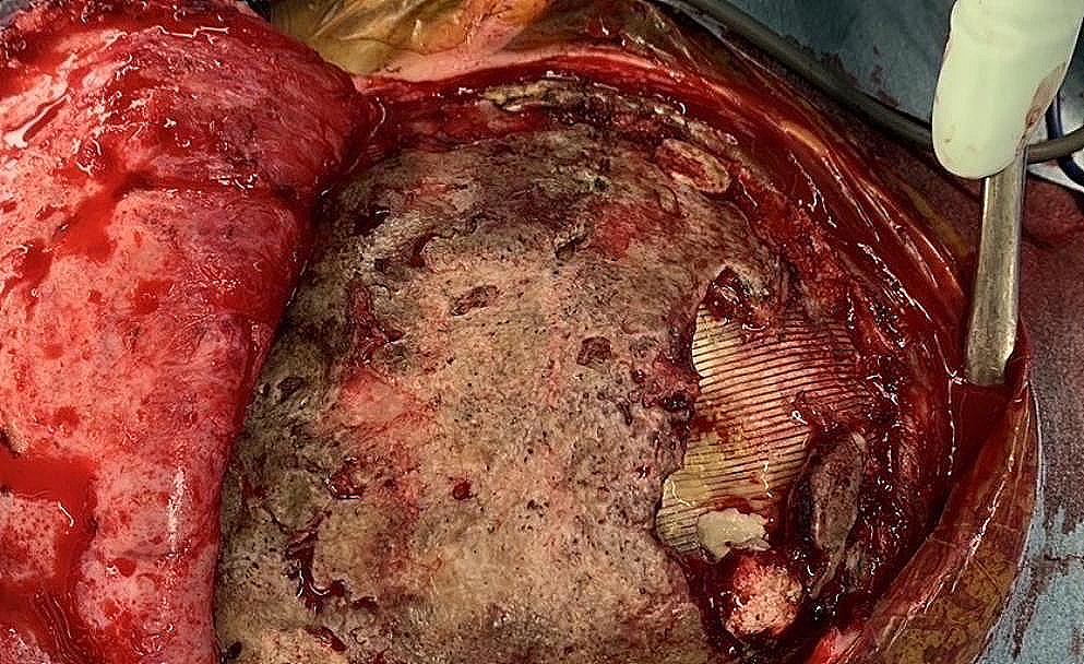 Minocycline-induced black bone disease of the skull