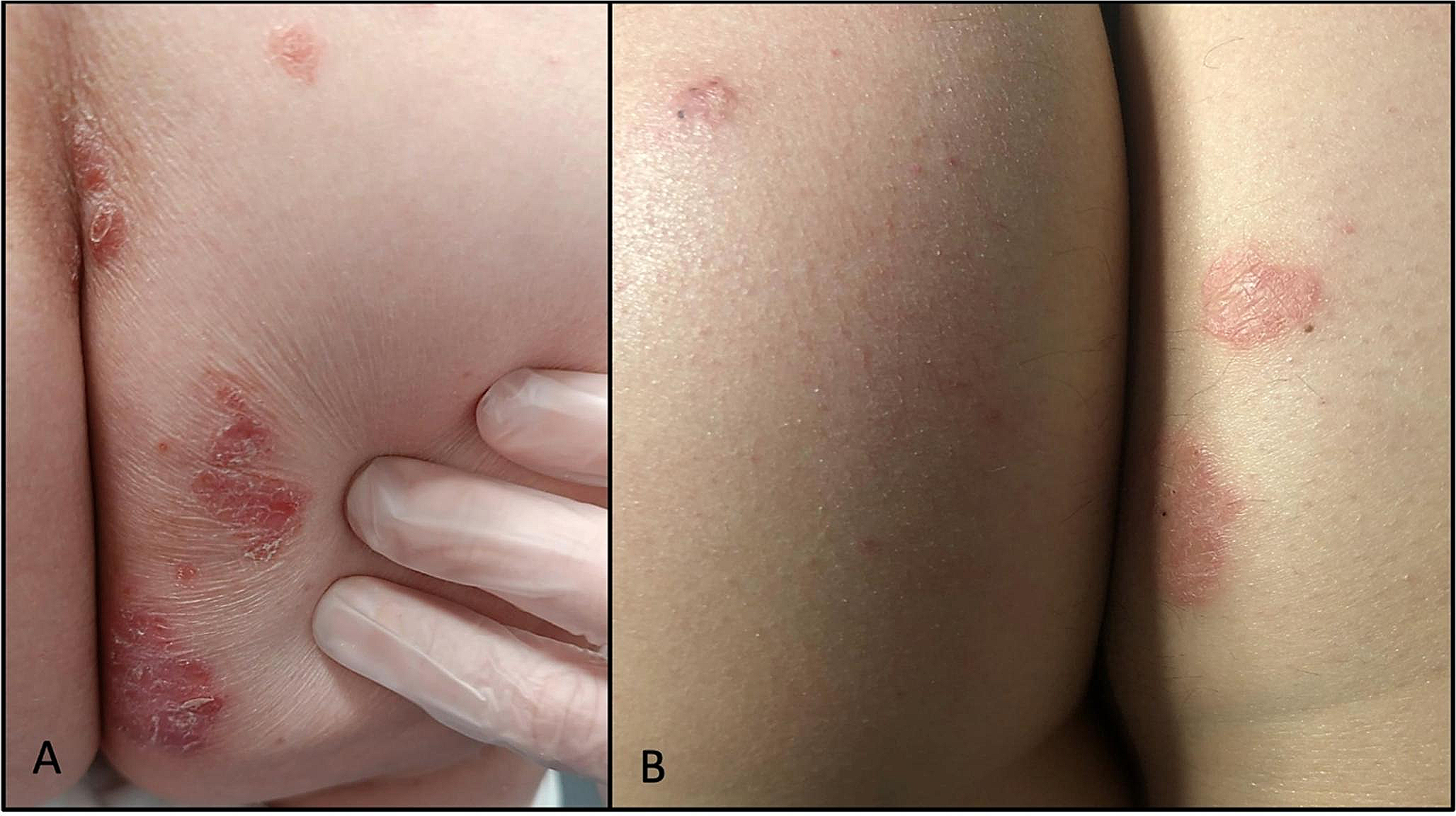 Tinea corporis caused by Trichophyton Equinum as occupational infection in riders