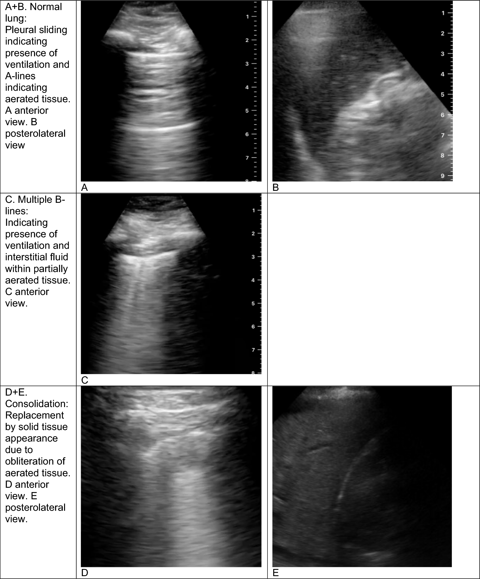 Lung ultrasound in pneumonia: a guide for effective implementation