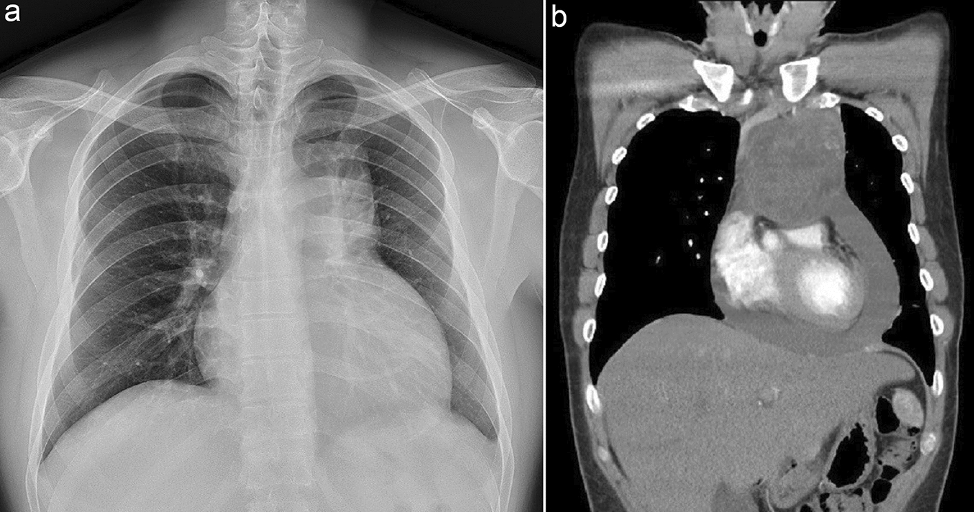 A mediastinal tumor with massive pericardial effusion