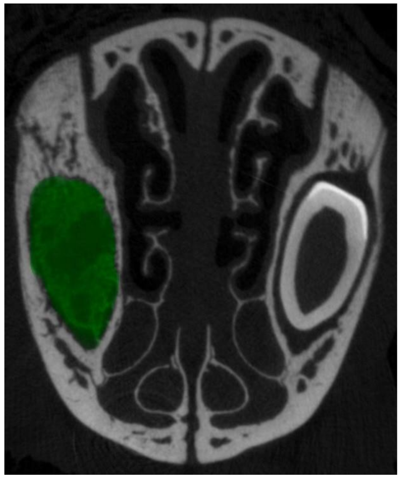 Socket preservation following tooth extraction: an experimental study comparing β-Tricalcium phosphate and F18 bioglass in rats