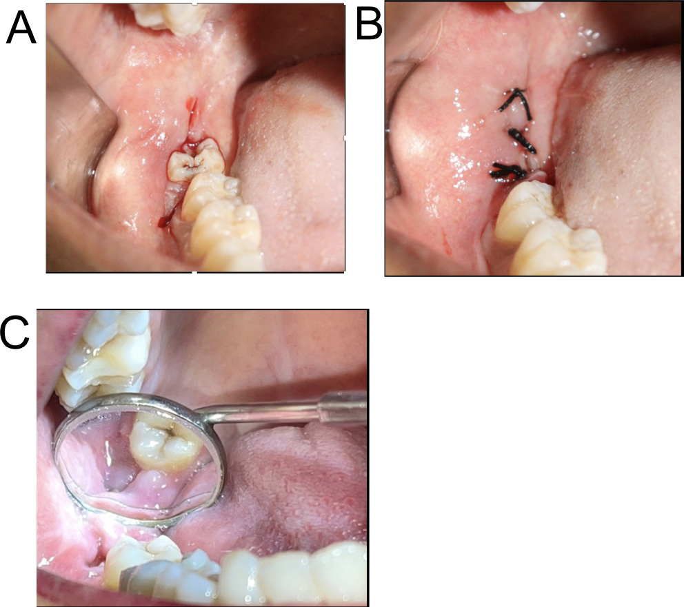 Analysing inflammatory responses after mandibular third molar extraction: a comparison of suture-less and multiple suture techniques