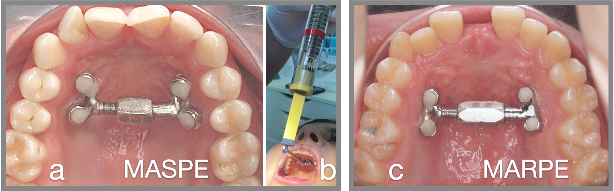 Adult maxillary expansion: CBCT evaluation of skeletal changes and determining an efficiency factor between force-controlled polycyclic slow activation and continuous rapid activation for mini-screw-assisted palatal expansion - MASPE vs. MARPE