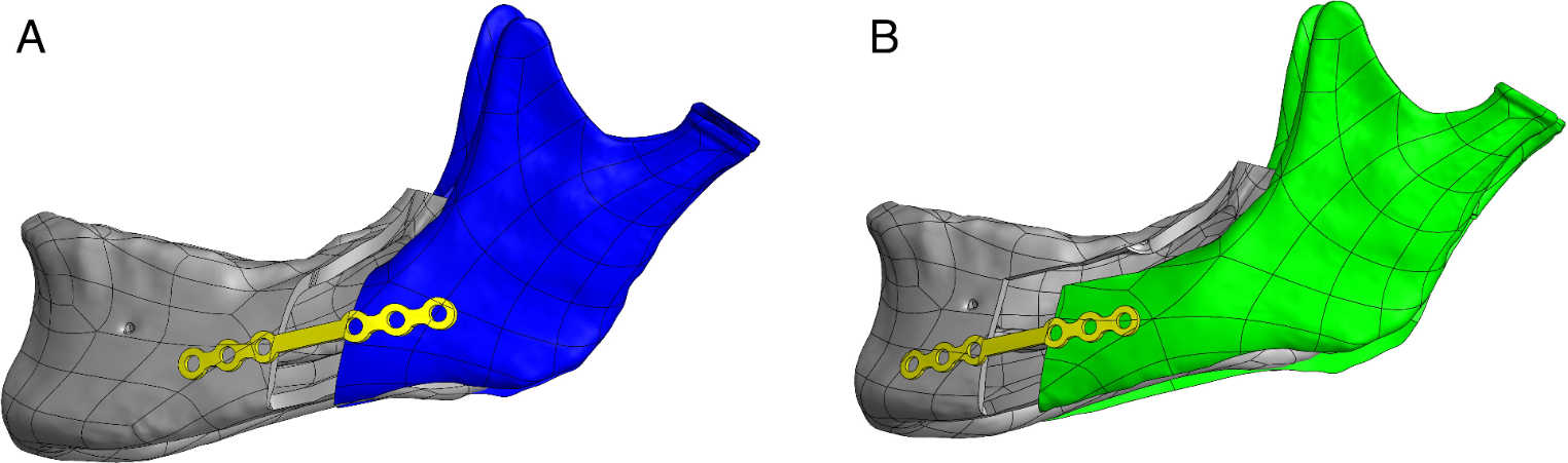 Biomechanical evaluation of stability after mandibular sagittal split osteotomy for advancement by Obwegeser–Dal Pont and Puricelli techniques using three-dimensional finite elements