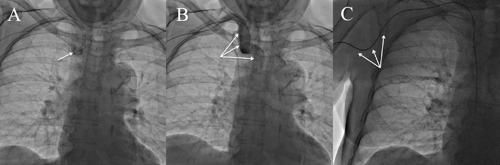Contrast-induced encephalopathy with visual and auditory hallucinations triggered by coronary angiography with iodixanol: a case report
