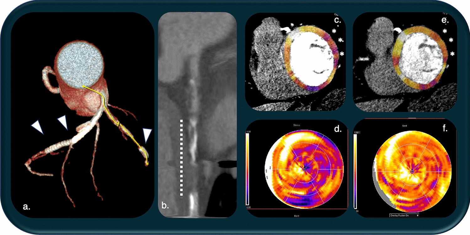 State of the art of CT myocardial perfusion