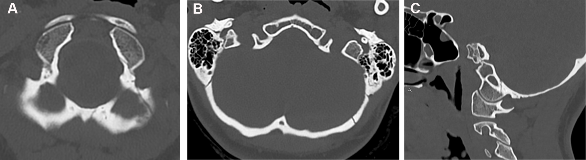 Occipital condyle fractures revisited