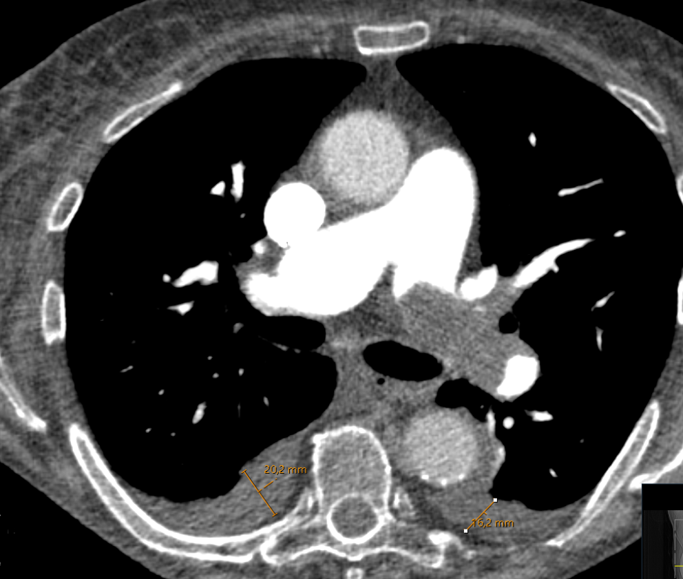 Pleural and pericardial effusions as prognostic factors in patients with acute pulmonary embolism: a multicenter study