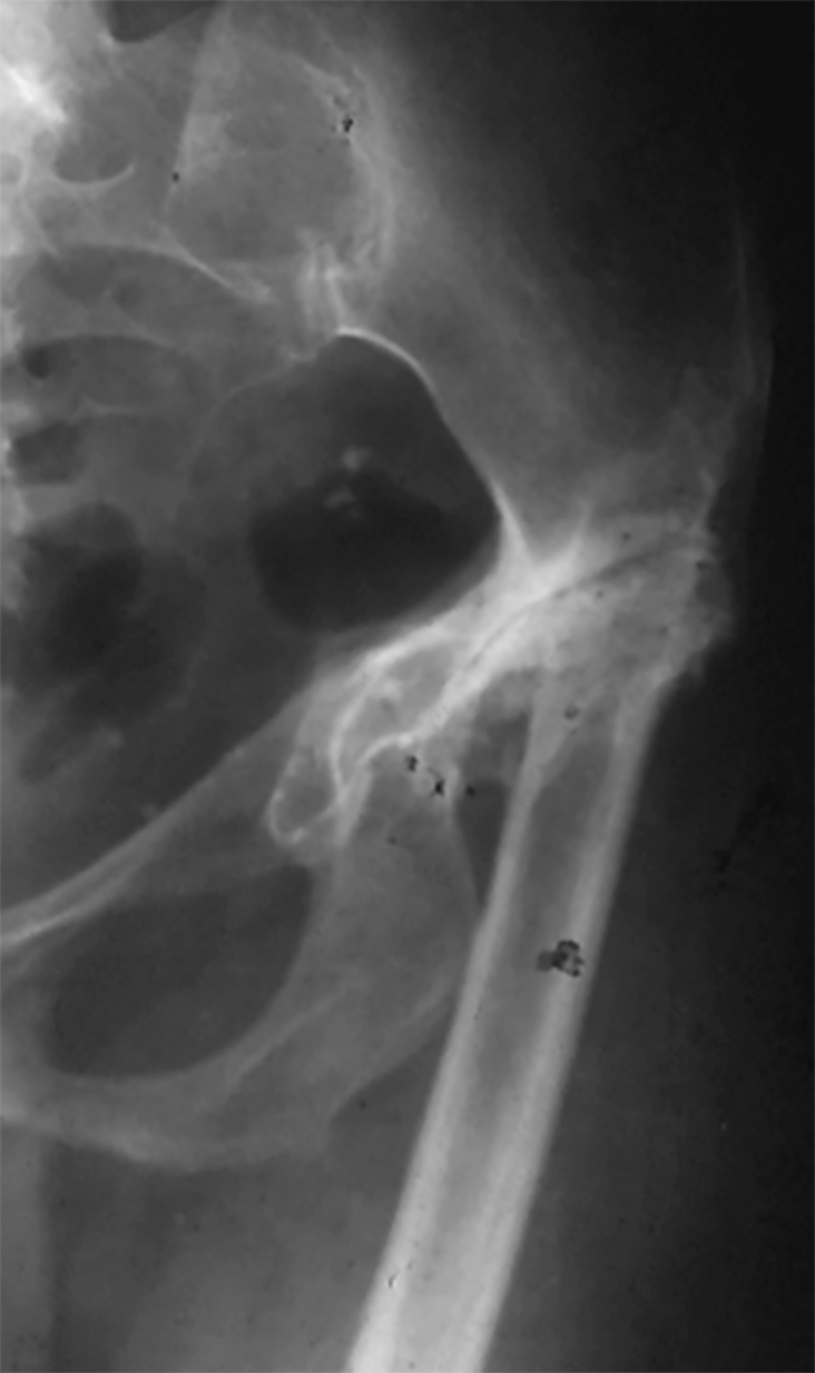 Subtrochanteric shortening osteotomy in adult sickle cell disease patients with cemented total hip arthroplasty for hip deformities secondary to childhood osteonecrosis: is healing a challenge?