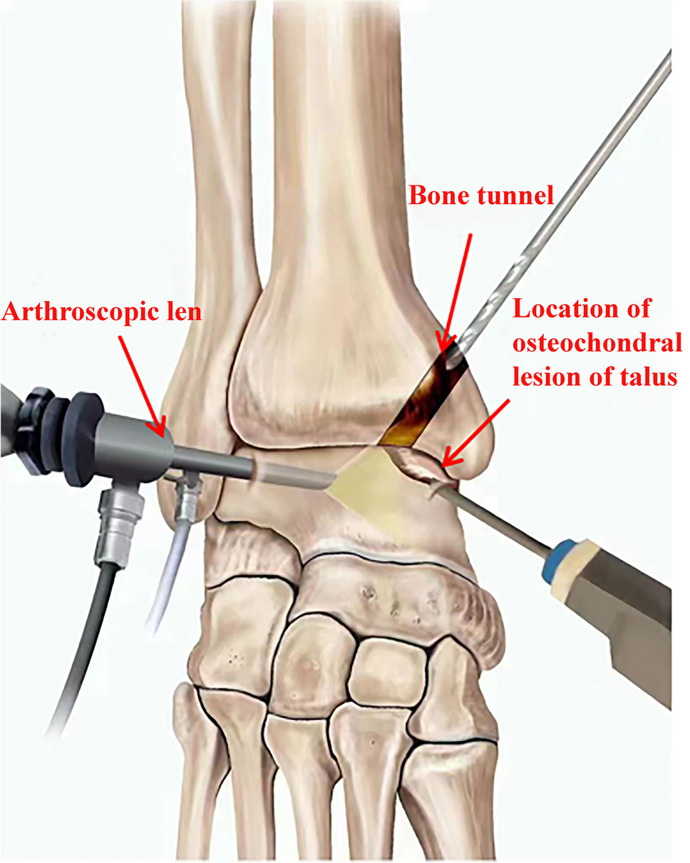 Arthroscopy combined with bone tunnel technique for treating Berndt and Harty stage III or IV osteochondral lesions of the talus