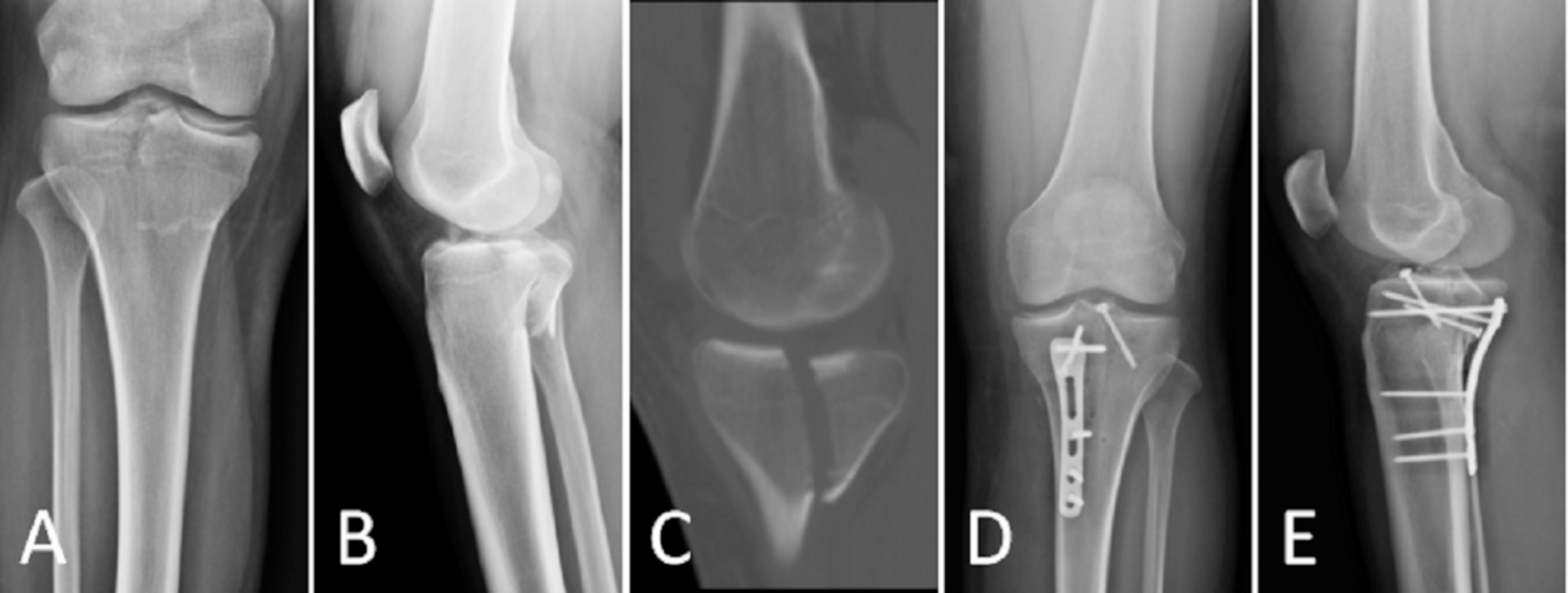 Long-term surgical outcomes of open reduction and internal fixation (ORIF) in patients with Hoffa-like tibial plateau fractures: a clinical study and analysis