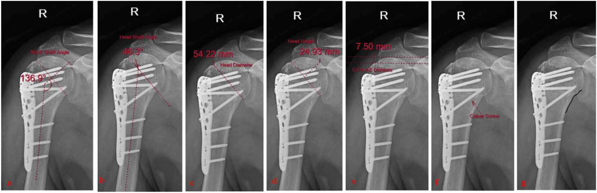 Correlation of radiological parameters with functional outcomes post fixation with proximal humerus locking plates
