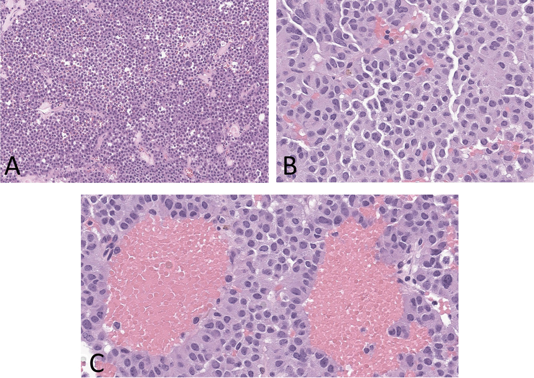 Multilineage Pituitary Neuroendocrine Tumors Expressing TPIT and SF1: A Clinicopathological Series of Six Tumors