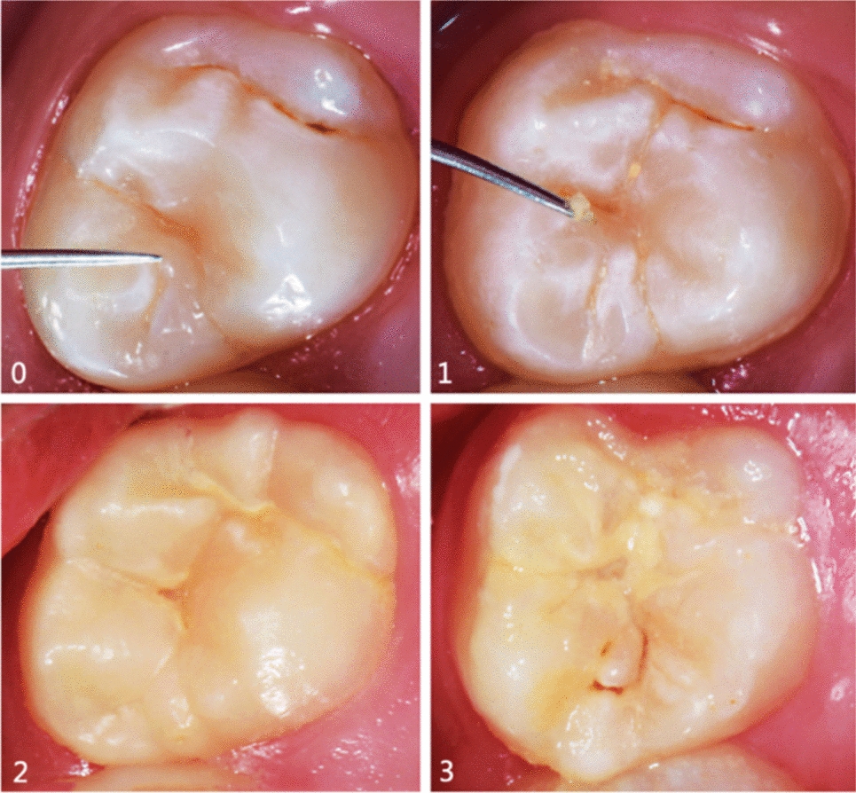 Quantitative analysis of Streptococcus mutans, Bifidobacterium, and Scardovia Wiggsiae in occlusal biofilm and their association with Visible Occlusal Plaque Index (VOPI) and International Caries Detection and Assessment System (ICDAS)